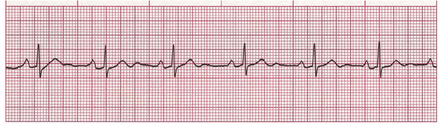 Contoh Soal Ekg