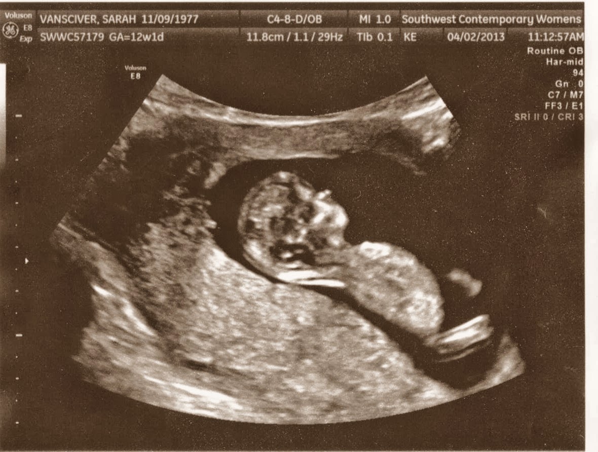12 недель и 1 день. УЗИ 12 недель беременности. Снимок УЗИ на 12 неделе. Снимки УЗИ беременности 12 недель. Снимок ребенка на УЗИ 12 недель.