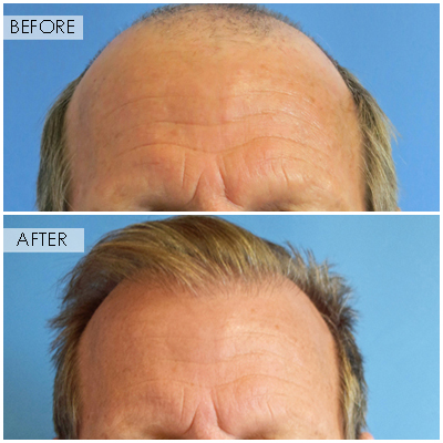 Best Hair Transplant In Nyc Revive Fue Hair Restoration By Best