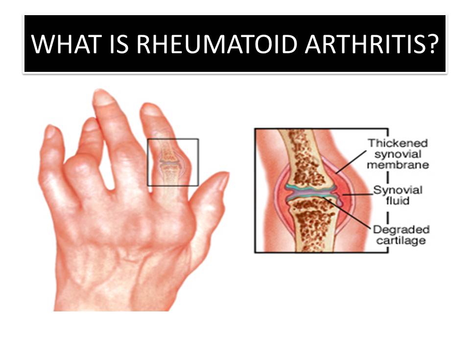 Arthritis латынь
