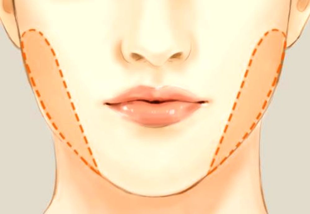 es una cirugía de Bichectomia? Paso a Paso OdontoVida