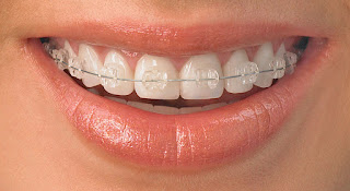 Các trường hợp niềng răng mắc cài sứ-1