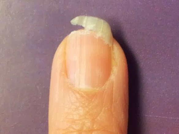 broken nail