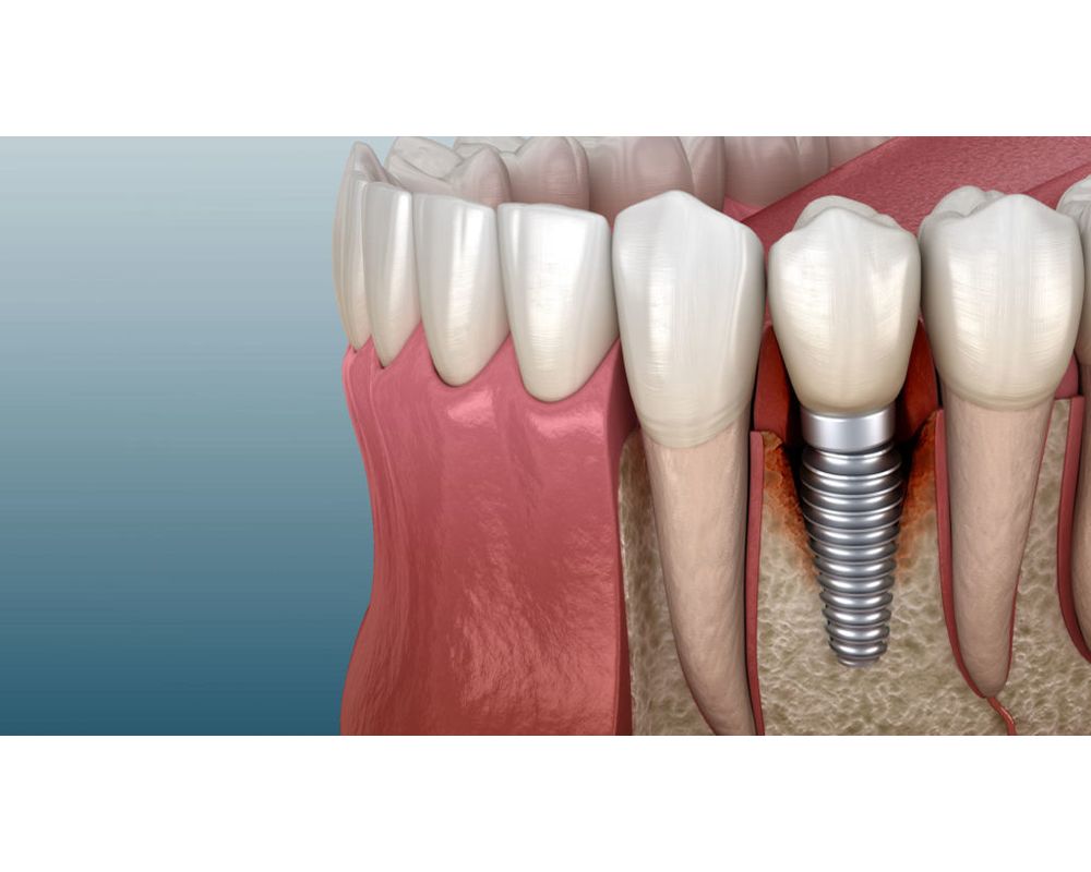 Potential Problems Associated with DENTAL IMPLANTS Directorio