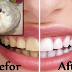 Whiten Your Teeth in Just 3 Minutes with Baking Soda and Lemon Mixture