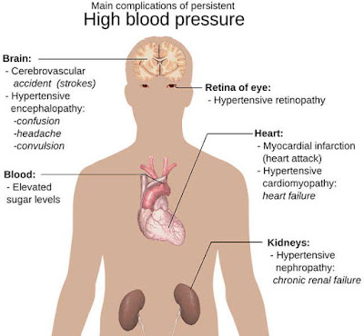 Complications of Hypertension