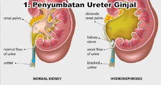 Penyumbatan Ureter Ginjal akibat sering Menahan buang air kecil