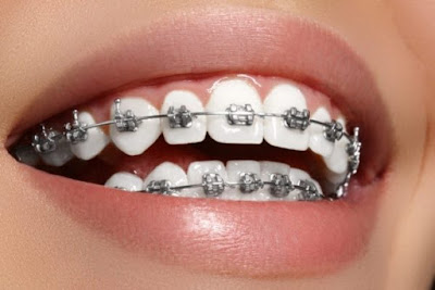 Phương pháp niềng răng người lớn 