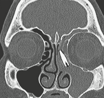 Dental implant ends up in woman's sinus