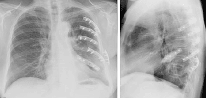Revision Casos De Cirugia General: TORAX INESTABLE O TORAX FLOTANTE: