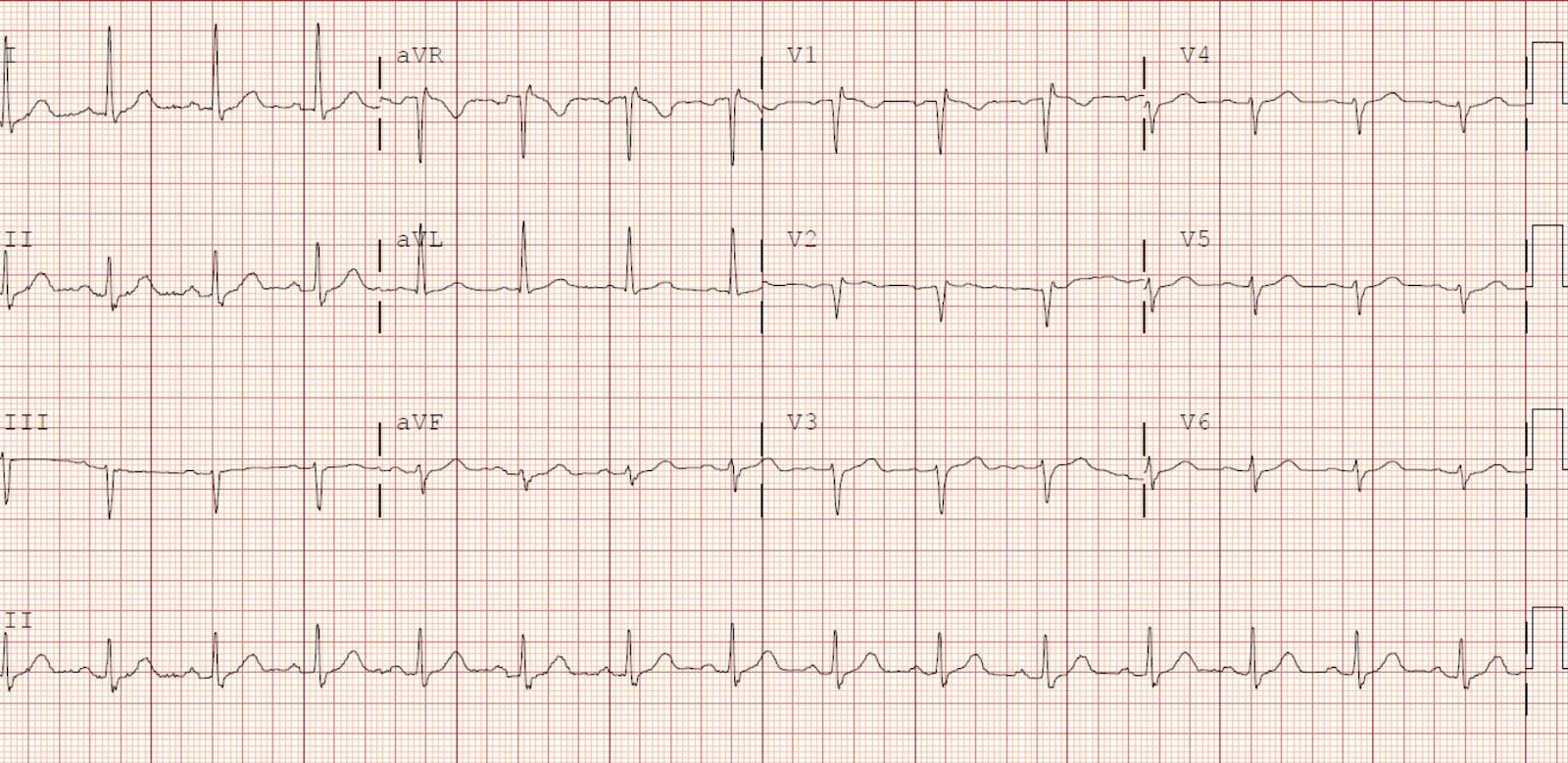 Dr. Smith's ECG Blog Hyperthermia and ST Elevation