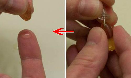 Chữa sẹo rỗ chỉ với rau má và vitamin chua-seo-ro-chi-voi-rau-ma-va-vitamin