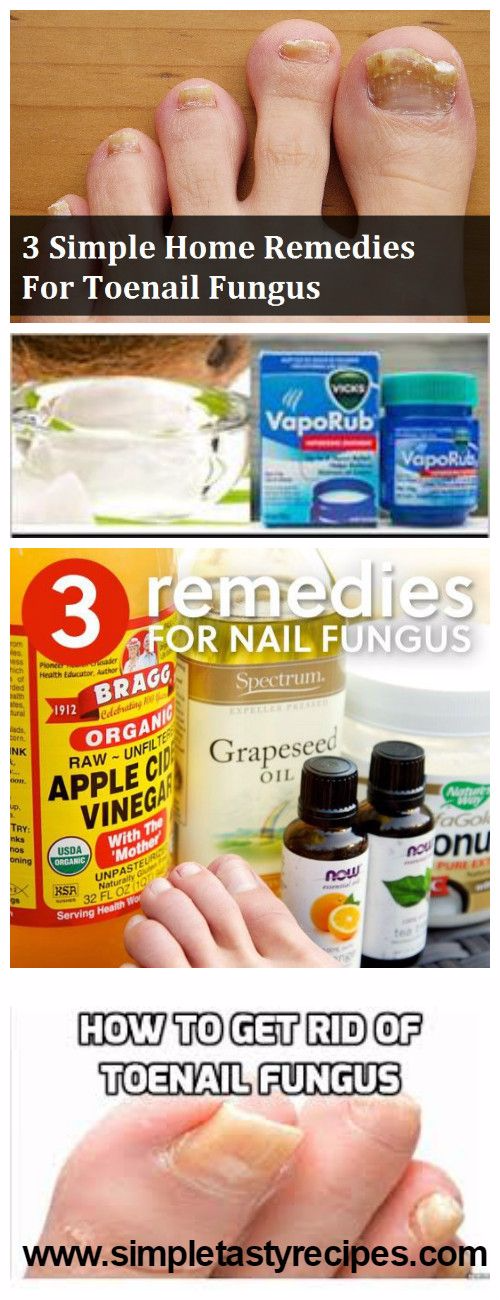 what is the most effective treatment for toenail fungus what is the most effective treatment for toenail fungus