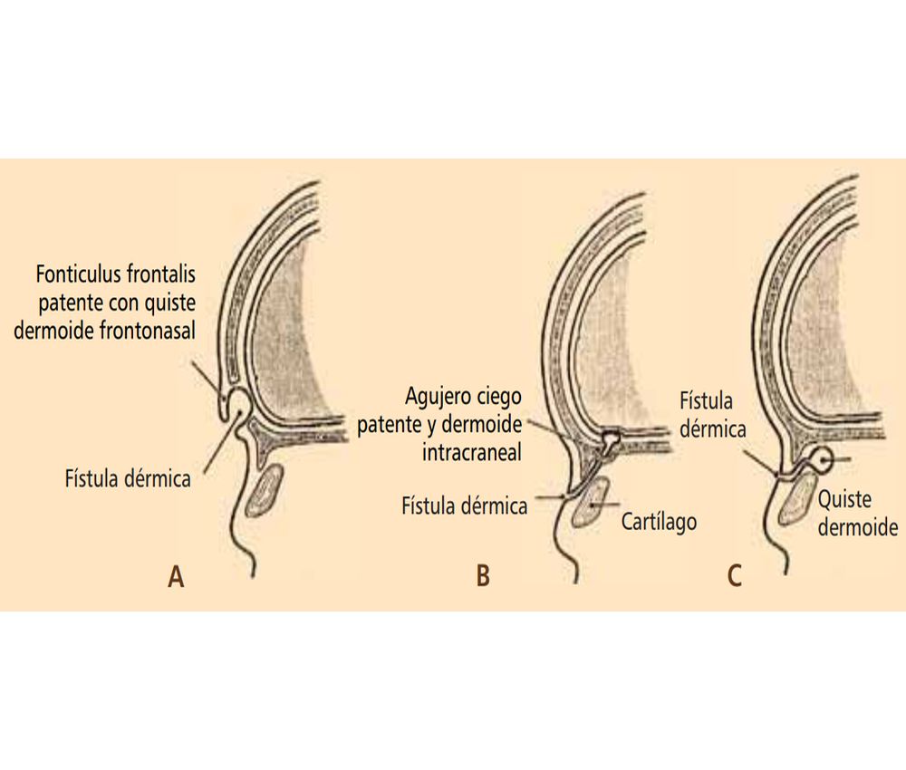 Defectos de la línea media: senos, fístulas y quistes - Embriología ...