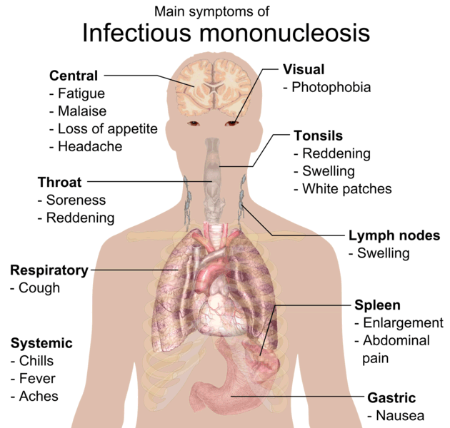 Mononucleosis symtomps