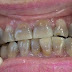 Răng xỉn màu kháng sinh có tẩy trắng được không? 