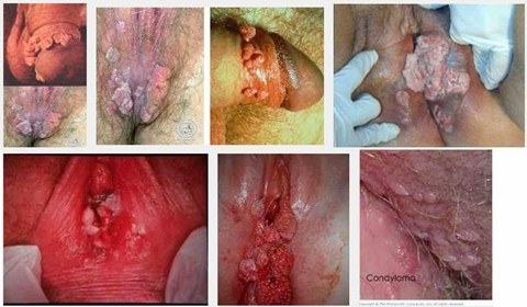 obat tradisional kutil pada kelamin width=480
