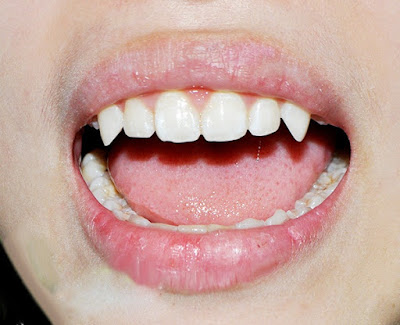 Mài răng nanh nhọn có nguy hiểm không? 