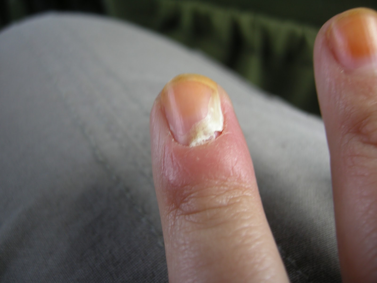 smilejustcoz Finger infection