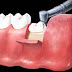 Nhổ răng khôn đau không? Những lưu ý cần biết