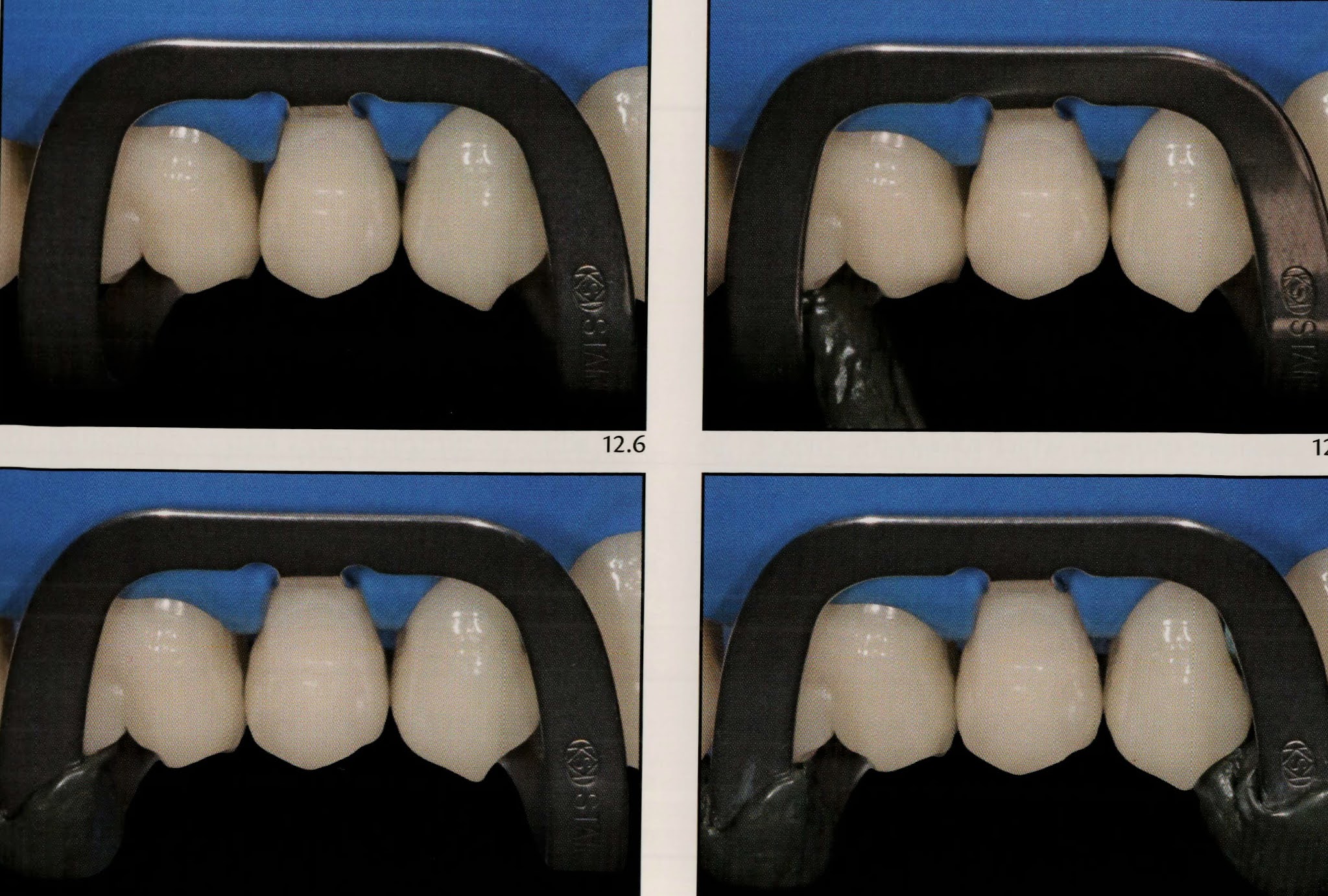 Class V composite restoration " Noncarious lesion " Dental Esthetics