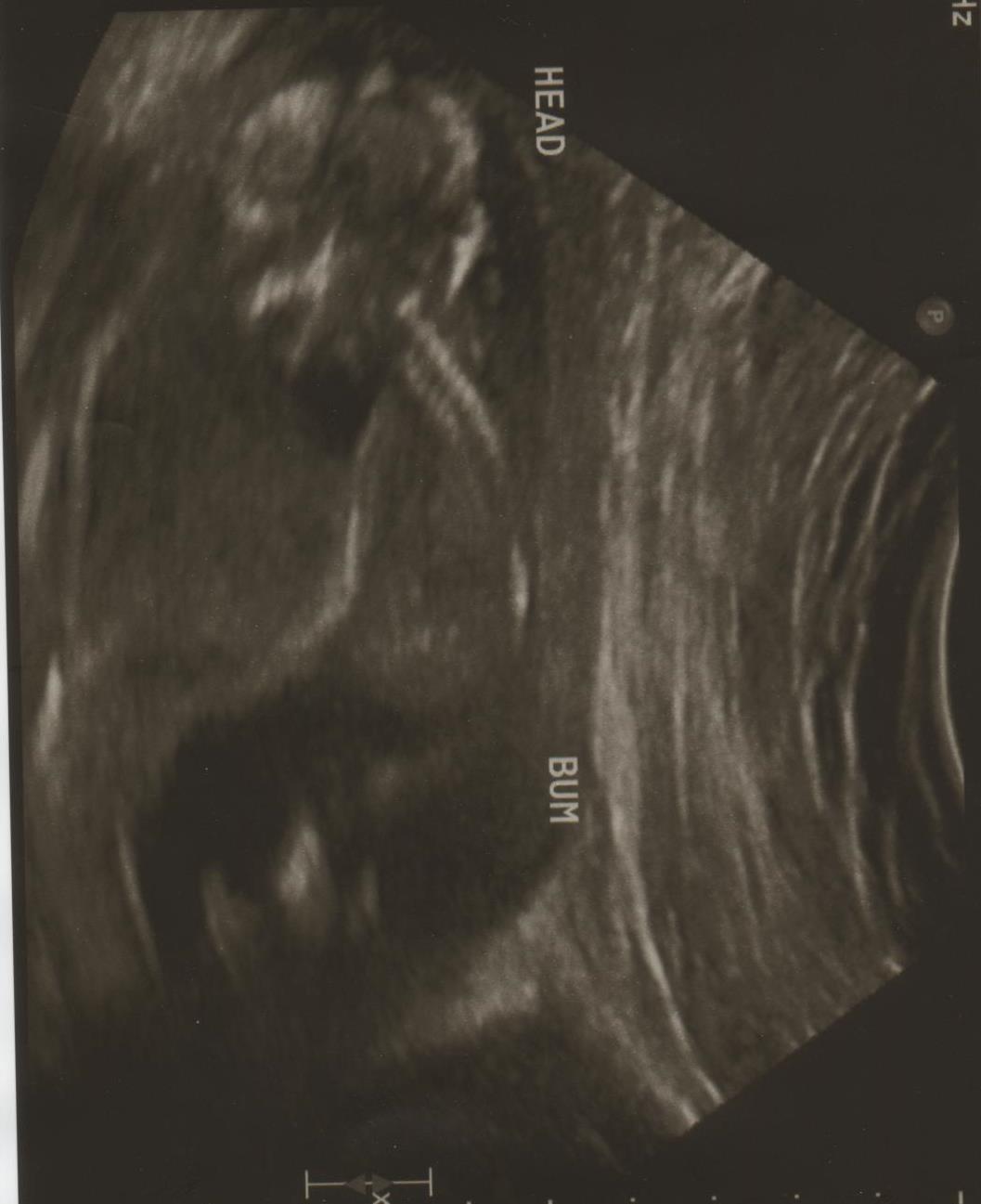 Life With My Girls Kell Antigen and Antibodies