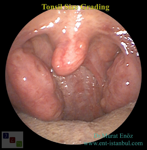 Tonsil Size Grading