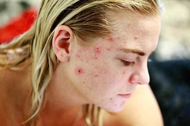 How to get rid of pimples and acne quickly?