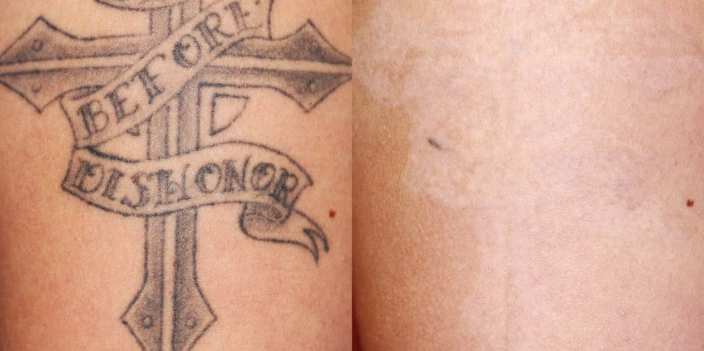 ... , Birthmark &amp; Tattoo Removal With Medlite C6 Laser | Mediviron UOA KL