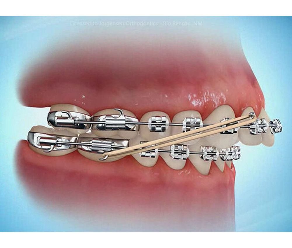 What Are Orthodontic Elastics? OdontoVida