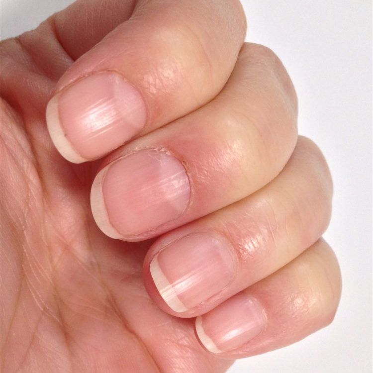 Iron Deficiency Anemia Nails