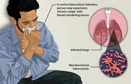 Askep TB Paru Dengan Pendekatan 3S, SDKI SLKI dan SIKI