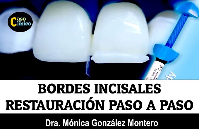 BORDES INCISALES: Restauración Paso a Paso - Caso Clínico 3M ESPE