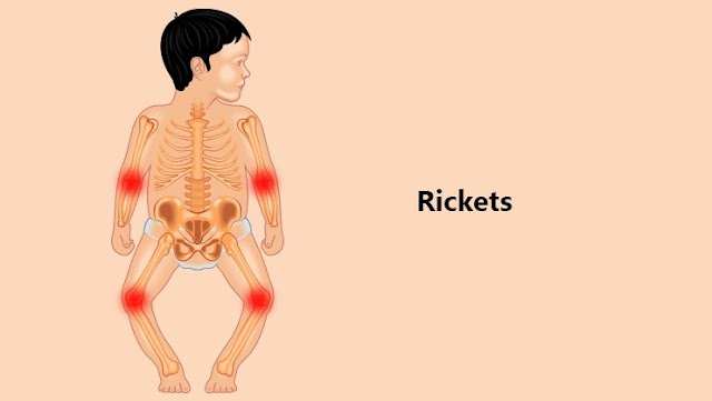 TIPS FOR RICKETS IN CHILDREN THAT MOTHERS SHOULD KNOW