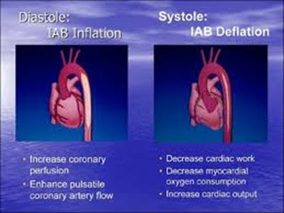CVT Mohd Farid: Basic Intra Aortic Balloon Pump IABP