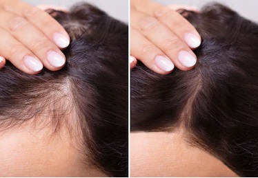 How Do You Treat Hair Loss Naturally Beautifulyhealthy