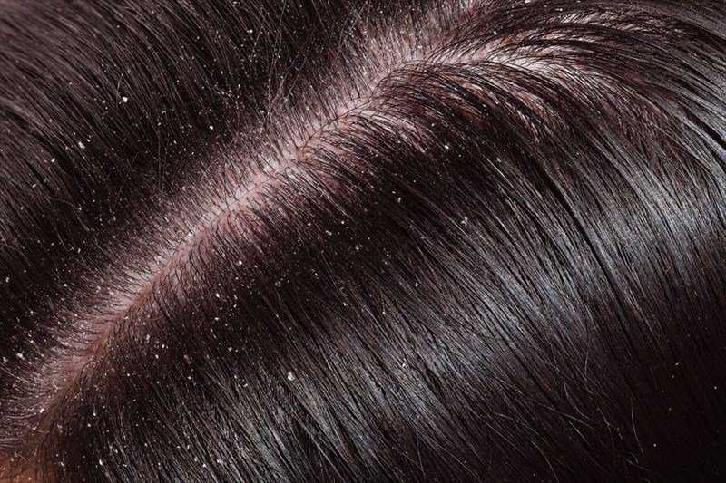 How to remove Dandruff at home naturally! | Health and Fitness ~ Health