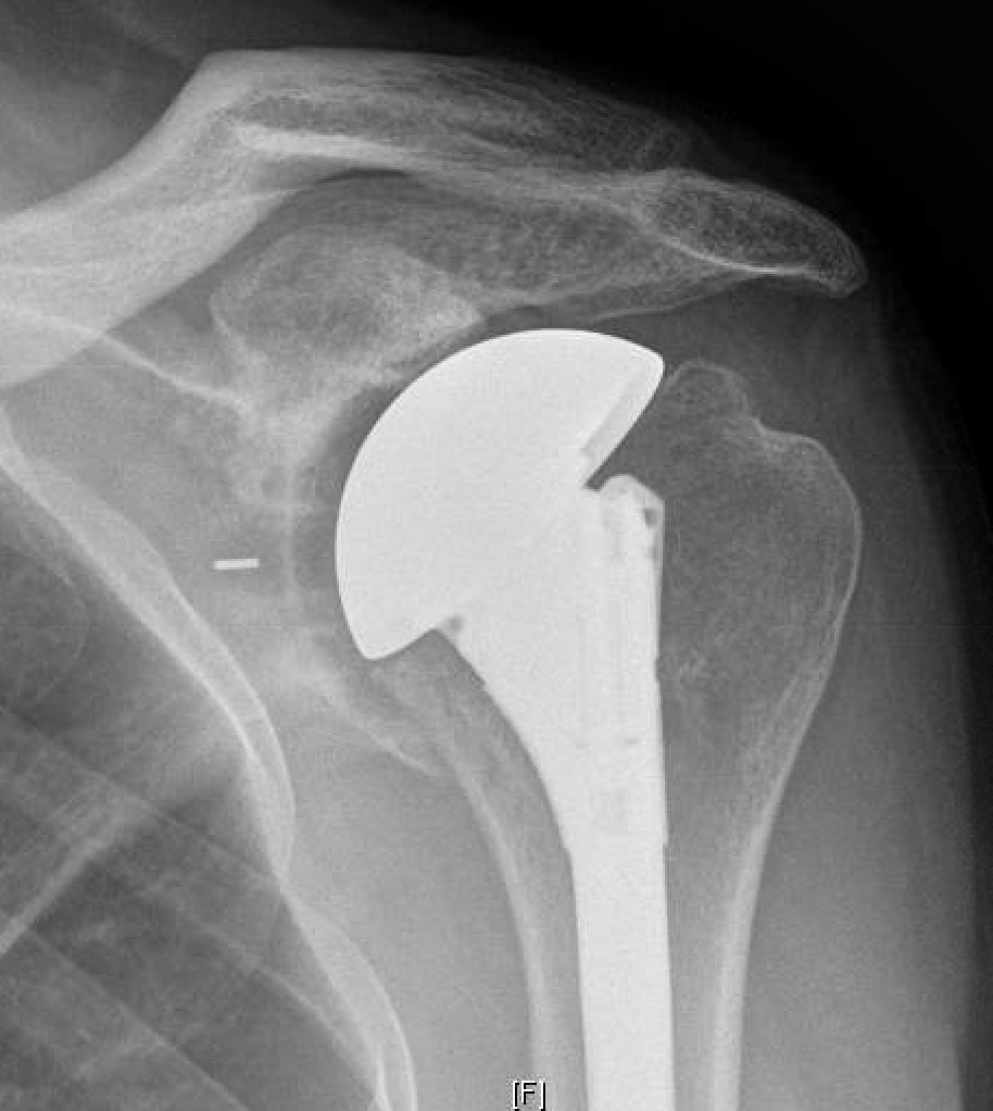 UW Shoulder and Elbow Academy How to treat arthritis in a 30 year old