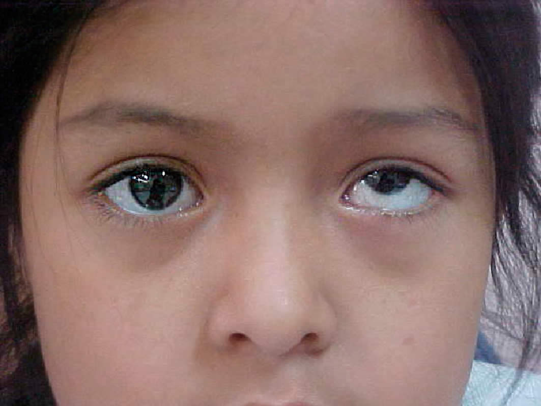 Eye 2 Eye Optometrists Vertical Strabismus Definition Types