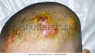 Scalp Folliculitis Treatment Scalp Folliculitis Treatment