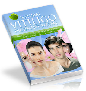 Natural Vitiligo Treatment