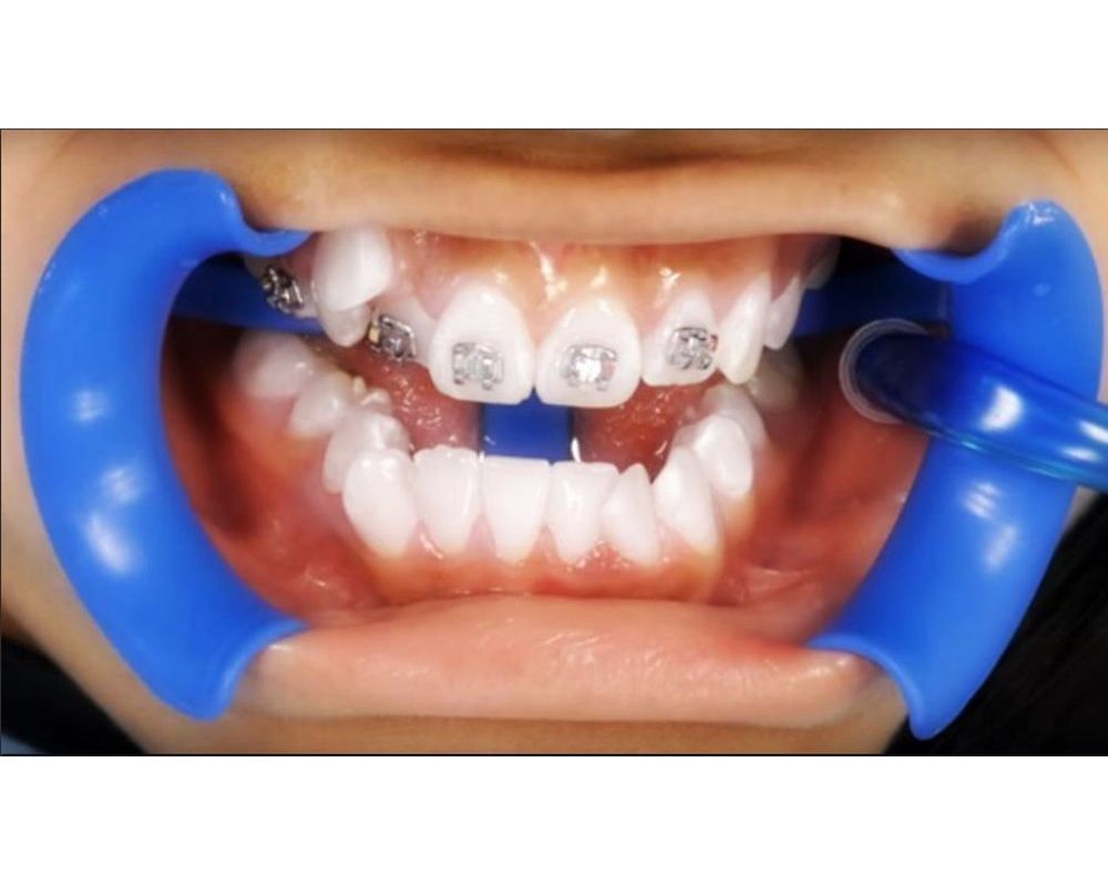 ORTODONCIA ¿Cómo es la colocación de Brackets? Directorio Odontológico