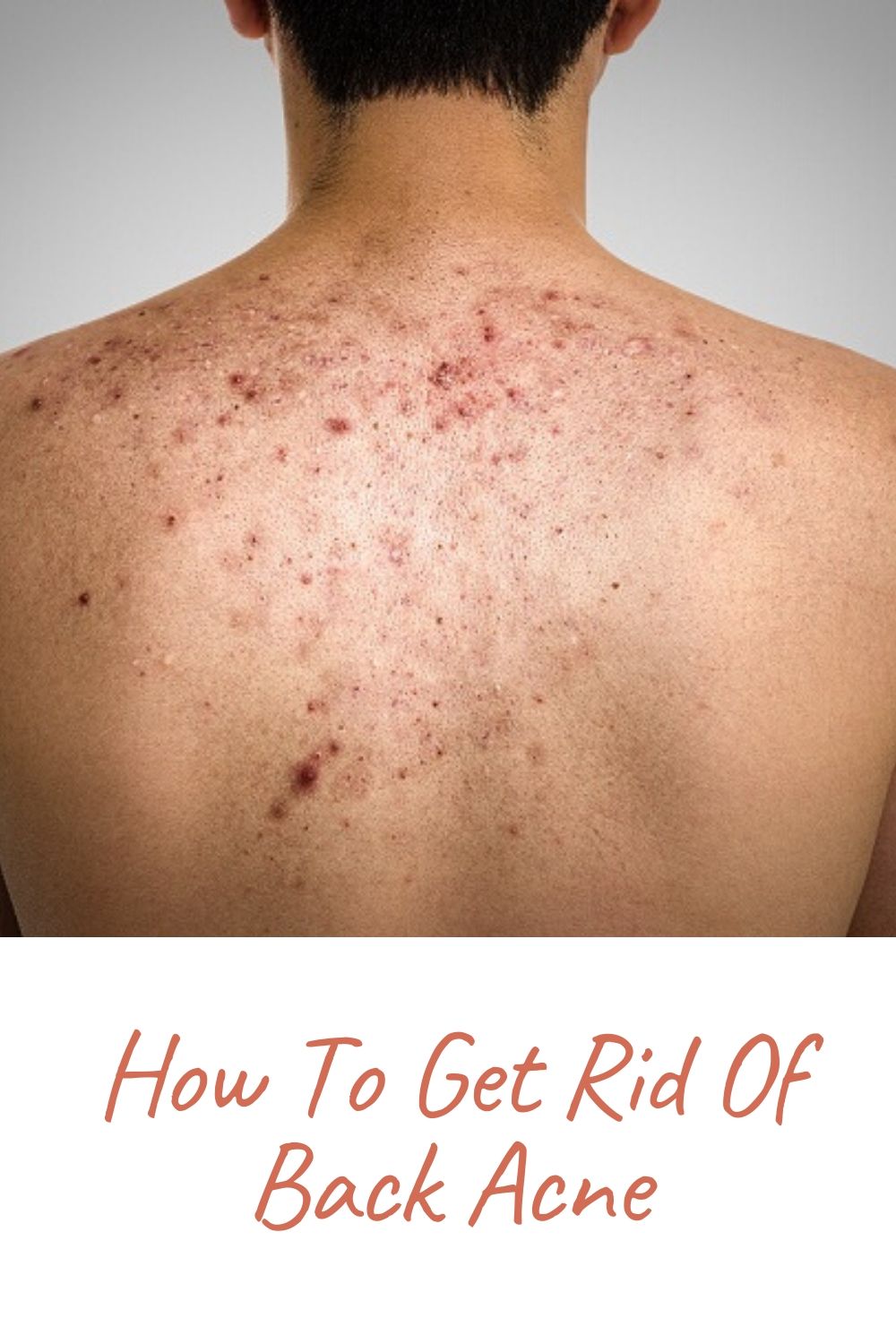 How To Get Rid Of Back Acne Pukrol Satwa