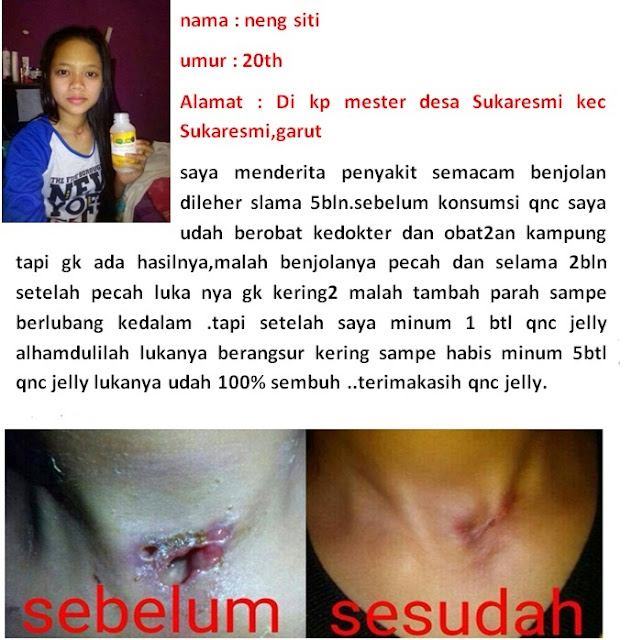 Cara Menghilangkan Benjolan Di Daun Telinga Kanan Dan Kiri Tanpa Operasi ~ TESTIMONI QNC JELLY GAMAT Cara Menghilangkan Benjolan Di Daun Telinga Kanan Dan Kiri Tanpa Operasi ~ TESTIMONI QNC JELLY GAMAT