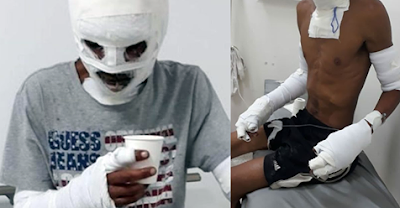 Un hombre de Colombia sufre graves quemaduras por salvar la vida de 8 perritos