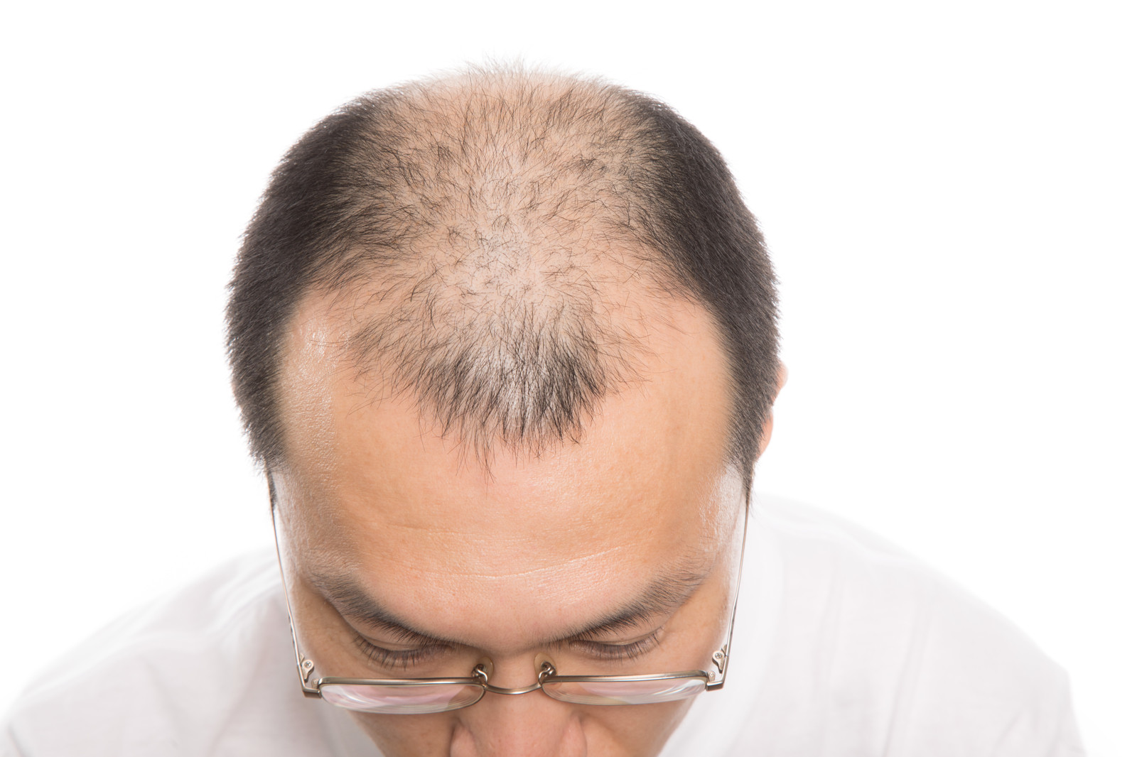 最新のはげ 薄毛対策 30代 60代男性の6割が薄毛を自覚
