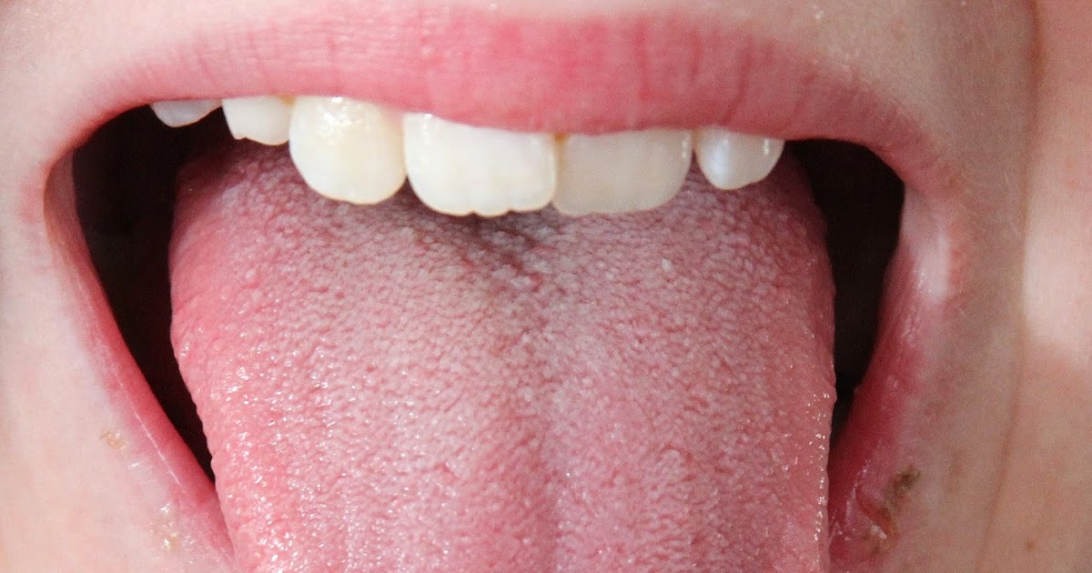 Allergies Swollen Tongue