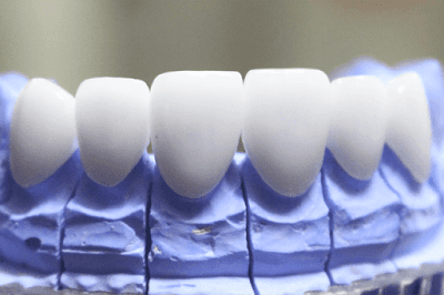 Ai nên bọc răng sứ?