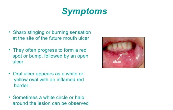 Mouth Ulcers On Back Of Throat