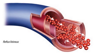 Retour veineux difficile  maladie veineuse, jambes lourde